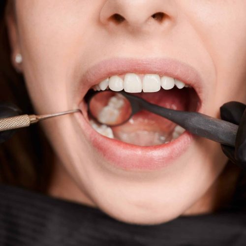 Close-up, cropped snapshot of good looking woman at dentist office during teeth checkup. Dentist examining patient's teeth with mirror and explorer. Oral hygiene concept