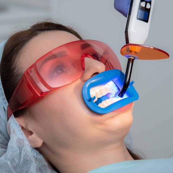 there is a preparation of the oral cavity to bleaching with the help of an ultraviolet lamp. Close-up